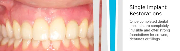 Completed dental implants