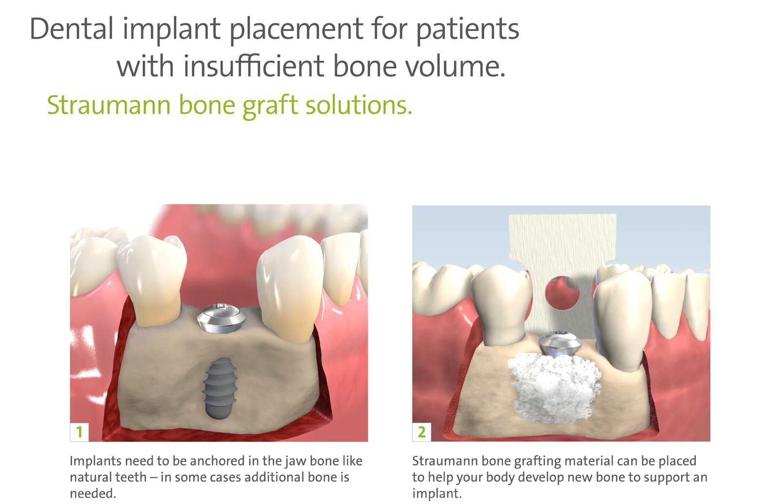 Dental implant placement for insufficient bone volume