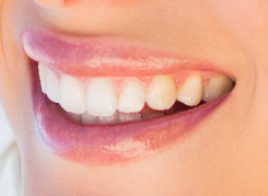 Implant supported Dentures