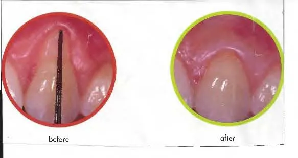 Receding gums before and after