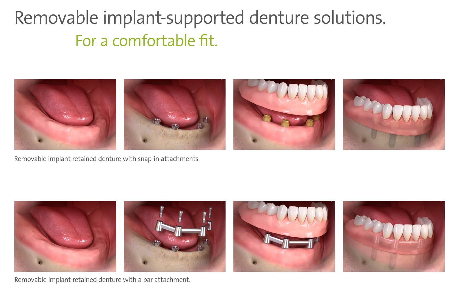 Removable Implant Supported Denture