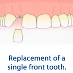 Replacement of a single front tooth