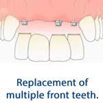 Replacement of multiple front teeth