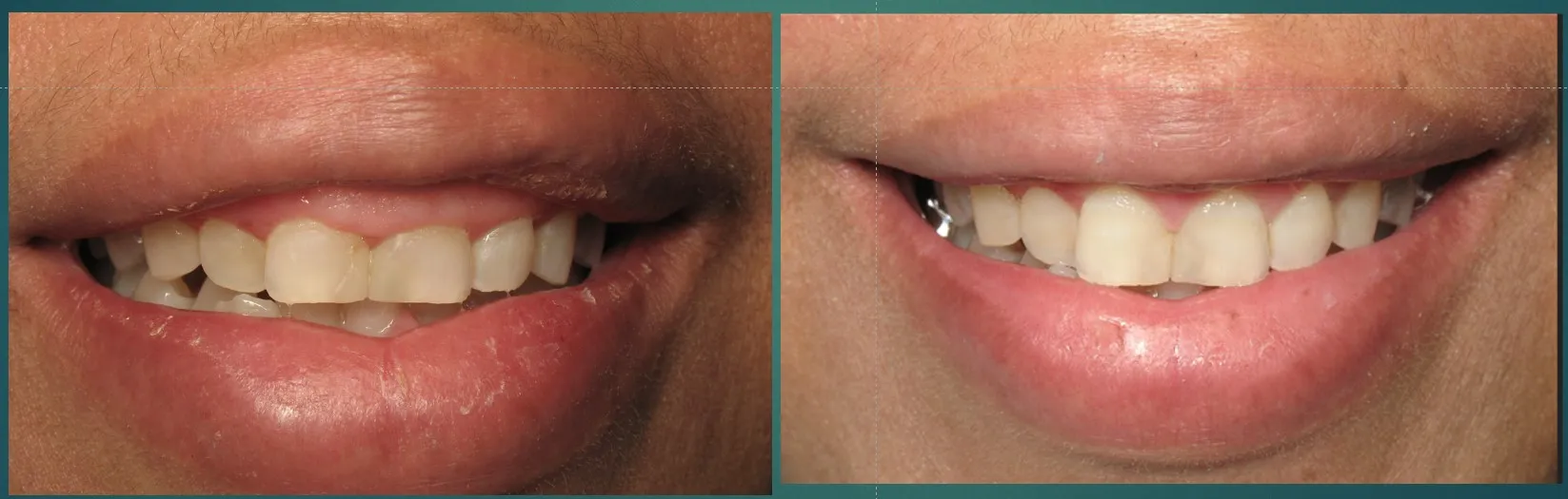 Gummy smile before and after